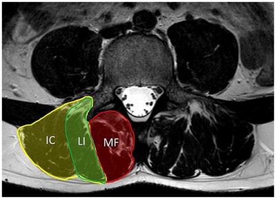 Trunk muscle dysfunction in patients with myotonic dystrophy type 2 and its contribution to chronic low back pain